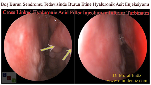 Boş burun sendromu tanımı - Boş burun sendromu belirtileri - Boş burun sendromu tedavisi - Boş burun sendromu tedavisinde Hyaluronik Asit dolgusu - Burun eti dolgusu - Treatment of Empty nose syndrome with hyaluronic acid filler - Boş burun - Geniş burun boşluğu sendromu - Burun eti büyütülmesi - Empty Nose Syndrome (ENS)