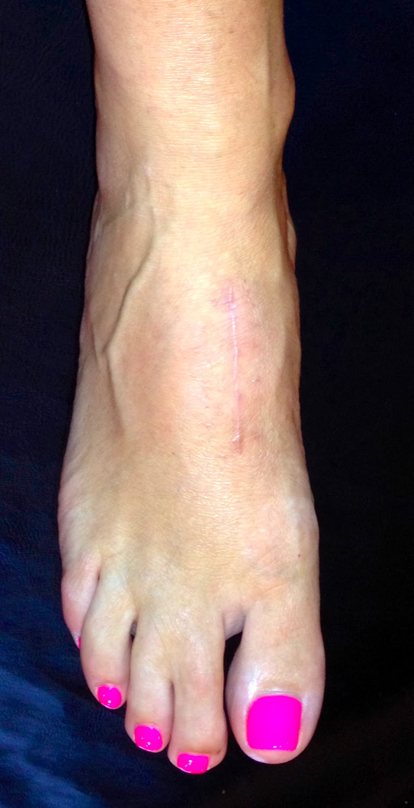 After LisFranc Surgery