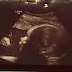 Ada Penampakan 'Yesus' di Hasil USG Bayi di Pennsylvania