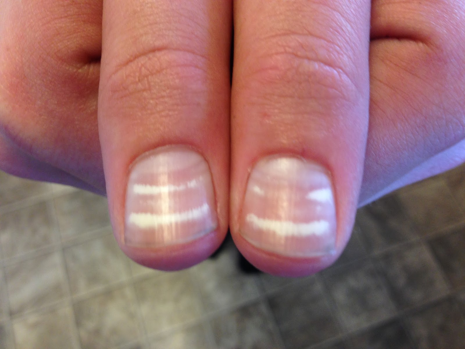 Our journey with Hodgkins Lymphoma Week two of radiation is done!