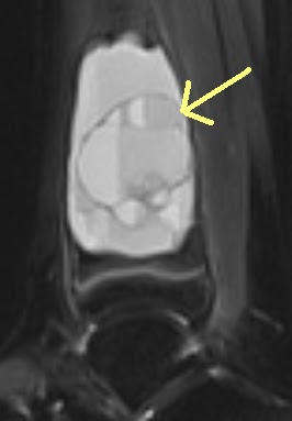mricases: Aneurysmal Bone Cyst