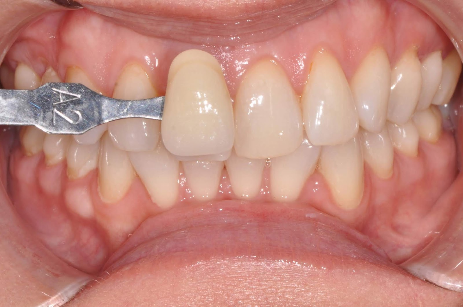 My Philips ZOOM! Teeth Whitening experience with before and after!