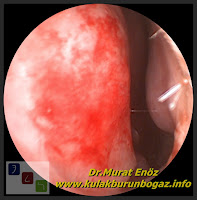 nose bleeding, bleeding of the nose, nosebleed,The main causes of epistaxis,