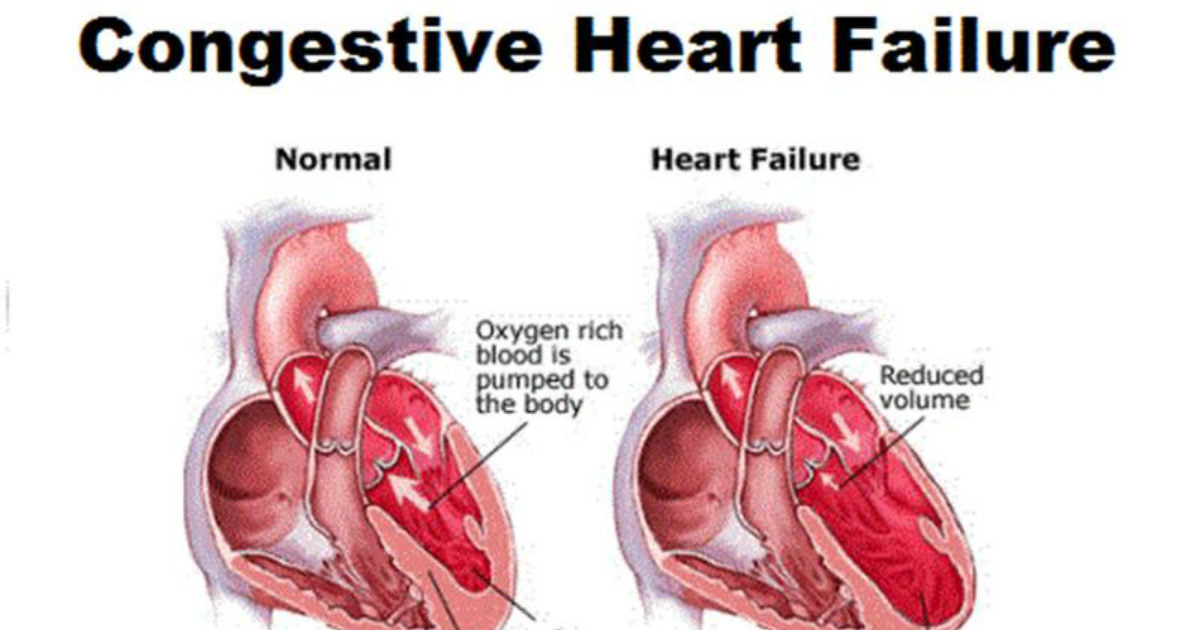 14 Signs and Symptoms That Your Heart Doesn’t Work