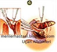 hemoroid basur mayasil cerrahi tedavi