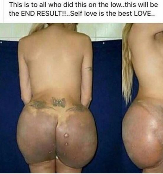 Plastic Surgery:Butt implants gone wrong(VIDEO) .