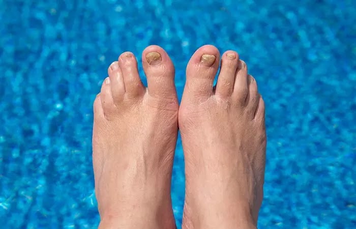 What Brittle Nails Say About Your Health And How To Fix It