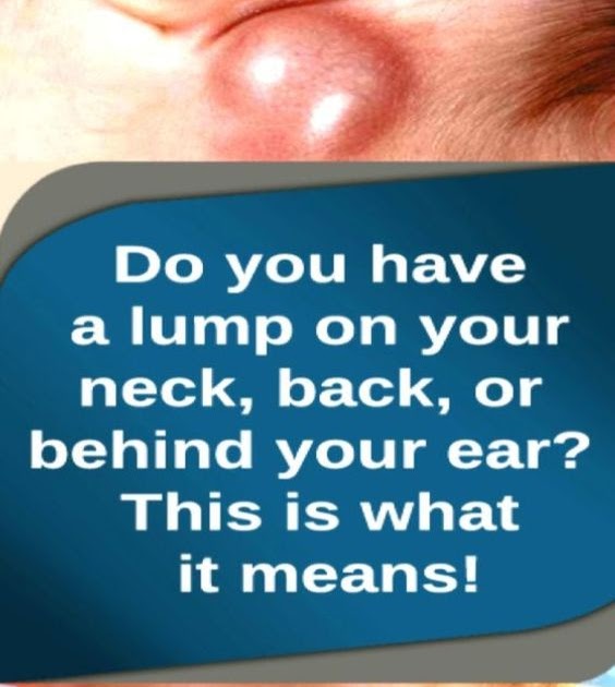 Do You Have a Lump on Your Neck,Back,or Behind Your Ear This Is What It