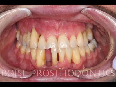 Boise Idaho Prosthodontics: True Immediate Maxillary Complete Denture ...