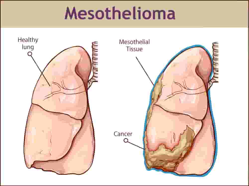 pemetrexed peritoneal mesothelioma