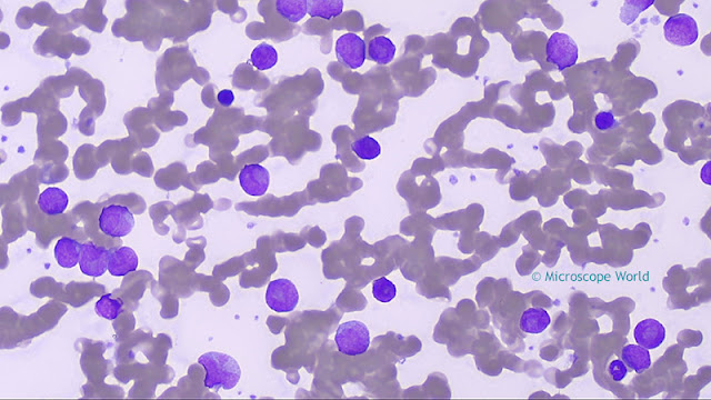 Microscopy image of Leukemia captured using a plan semi apochromat fluor objective lens (400x).