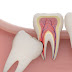 Nhổ răng khôn mọc lệch có nguy hiểm không ?