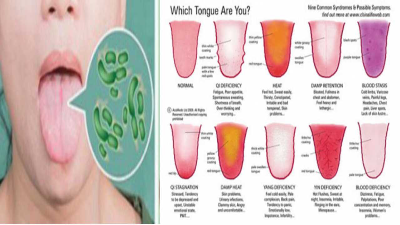Lidah Berubah Warna Tanda Anda Tidak Sihat, Bila Bertukar Bintik Merah