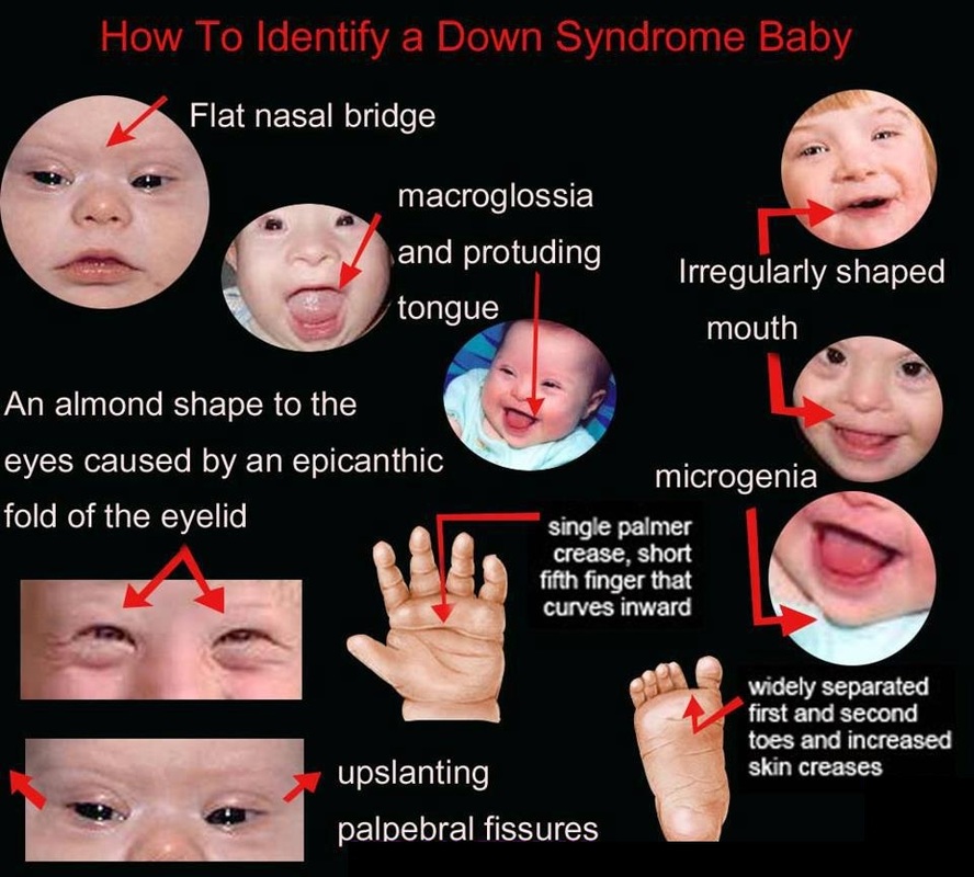 Indo American Hospital : Down syndrome