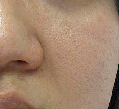 How To Reduce Facial Pore 67