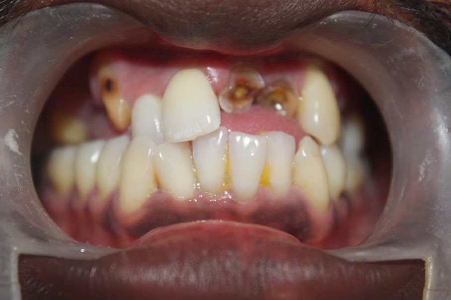 Severely decayed upper front teeth , extraction and immediate implant