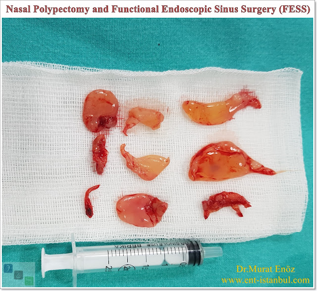 Nasal Polypectomy, FESS, Functional Endoscopic Sinus Surgery, Nose Polyp