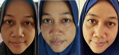 before after pemakaian acne serum jerawat berkurang