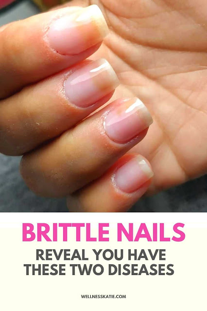 Things Your Nails Reveal About Your Health