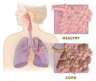 10 NANDA COPD Chronic Obstructive Pulmonary Disease | Nanda Books