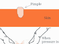 Pimple Diagram Pimple Diagram