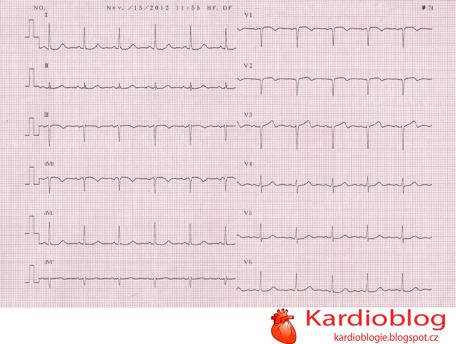 Kardioblog: (EKG Kazuistika #24) Pacientka s anamnézou CMP a subakutního IM