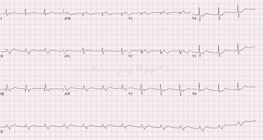 ECG Rhythms Accelerated Junctional Rhythm
