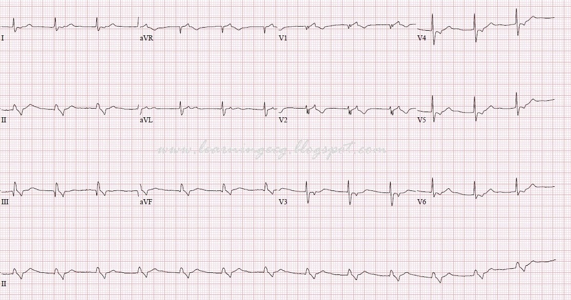 ECG Rhythms Accelerated Junctional Rhythm