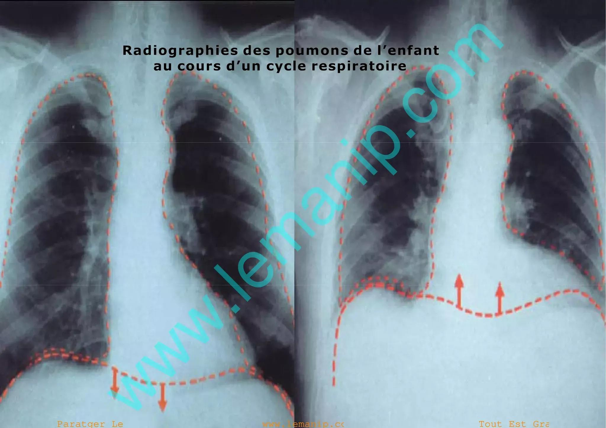 Radiographies des poumons de l’enfant  au cours d’un cycle respiratoire