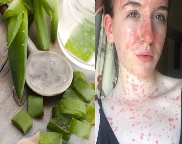 Traitement naturel du psoriasis à l'aloe vera Le soigner en 10 jours