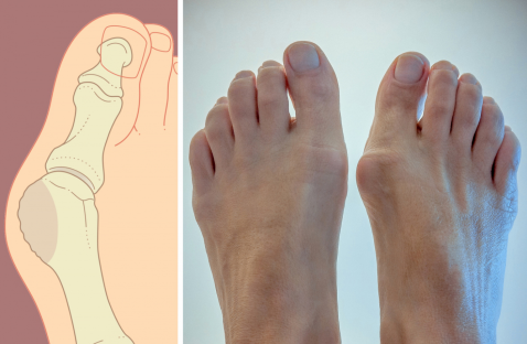 ''Toe Pro''- Trateaza Monturile (Valgus)