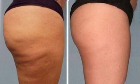 Massagens para celulite e gordura localizada Clearance