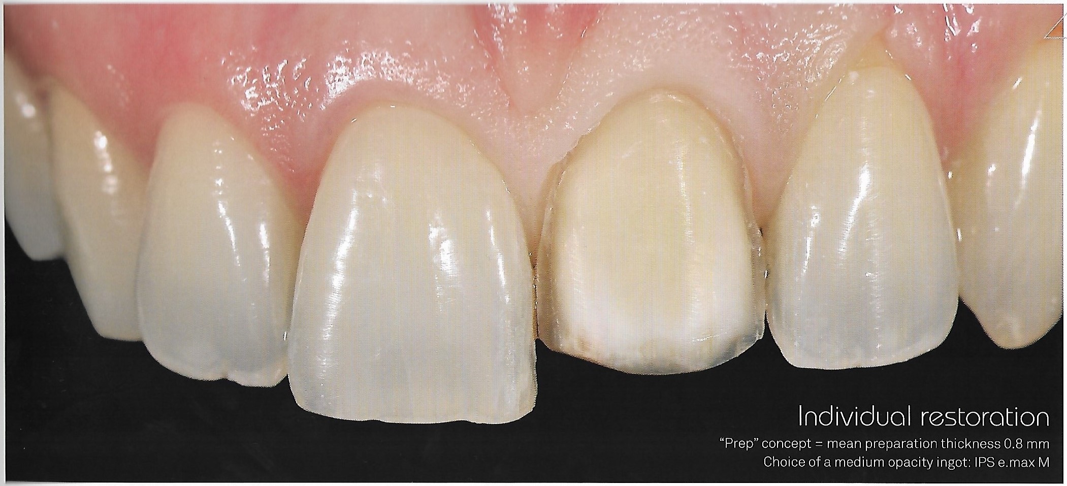 Why lithium disilicate (IPS e.max) for veneers? Dental Esthetics