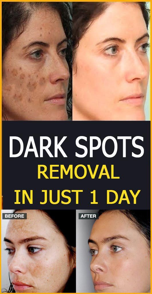 HEALTH KNOWLEDGE Dark spots removal in just 1 day