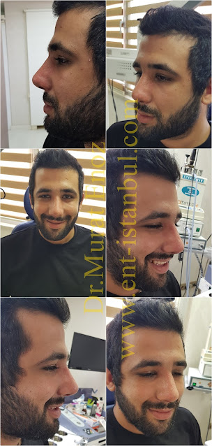 Thick Skinned Male Rhinoplasty Turkey,Nose Job For Men Istanbul,Droopy Nose Aesthetic For Men,
