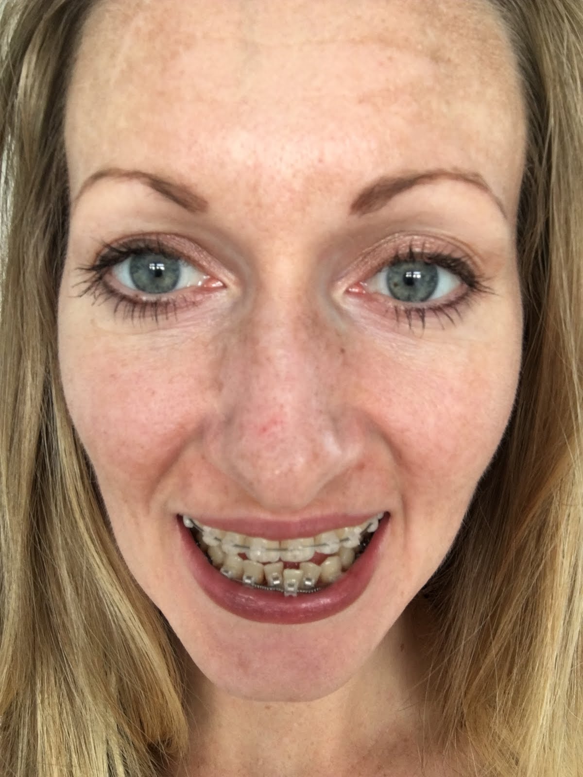 Alison's Jaw Surgery Blog Braces Progress