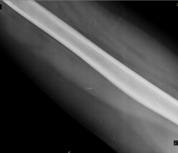 Retained Broken Injection NeedleMRI Sumer's Radiology Blog