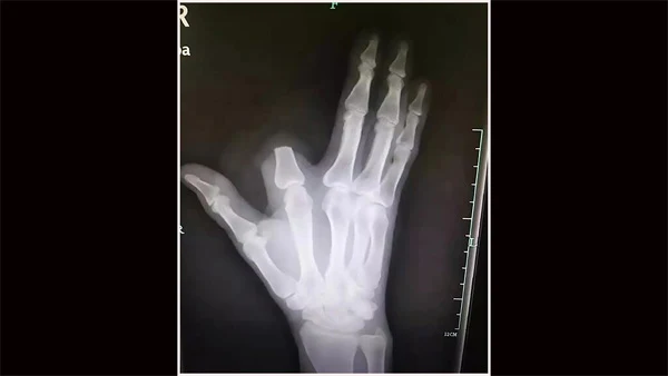 Man allegedly cuts finger off after snake bite 'to save my own life,' but doc says it was 'really unnecessary', Beijing, News, Snake, Doctor, Injured, China, World.