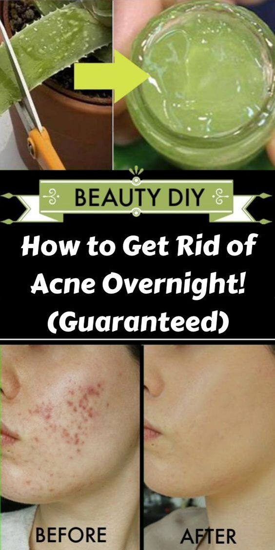 How To Get Rid Of Acne Overnight Guaranteed Healthy Lifestyle