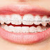 Niềng răng áp dụng chế độ ăn uống thế nào?
