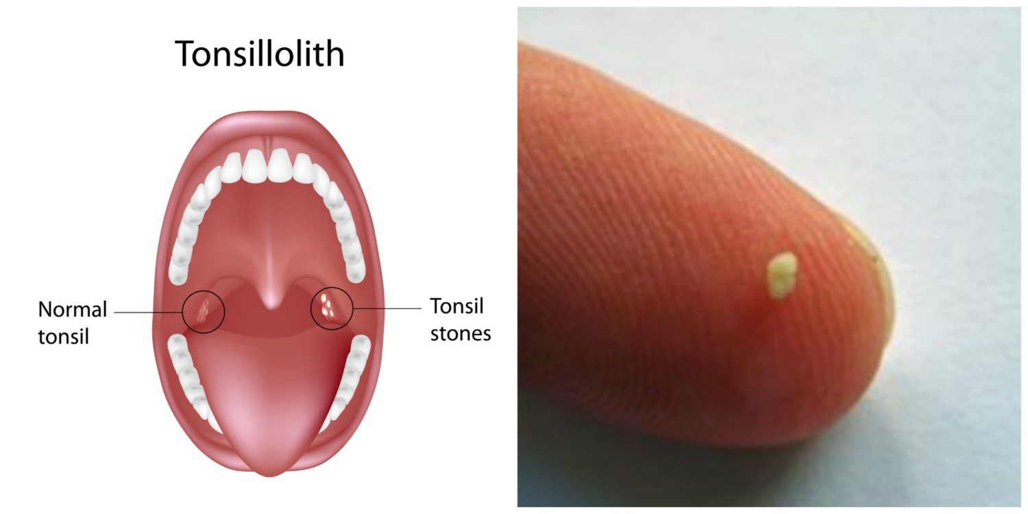 Healthy Living Tonsil Stones And Resulting Bad Breath