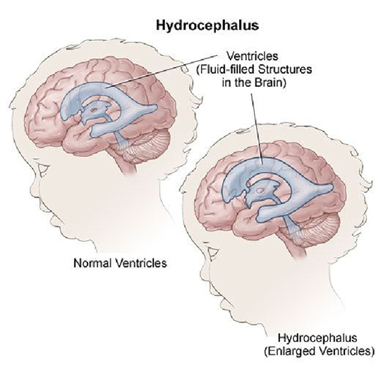 Гидроцефалия шунтирование мозга. Желудочки головного мозга при гидроцефалии. Гидроцефалия головного мозга у плода. Шунтированная гидроцефалия. Шунтирование гидроцефалии головного мозга.