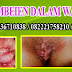 Obat herbal wasir berdarah di jawa timur thumbnail