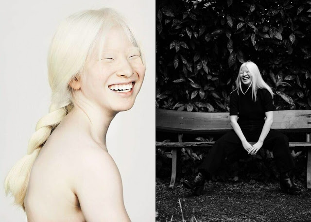 Родители избавились от дочки-альбиноса, отдав её в детдом, но спустя 16 лет красотка попала в Vogue