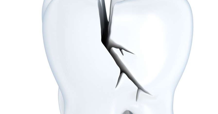 DentDesk: Cracked Tooth Syndrome