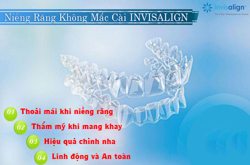   Niềng răng không mắc cài