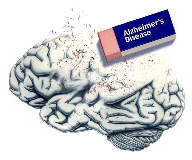 Αλτσχάιμερ