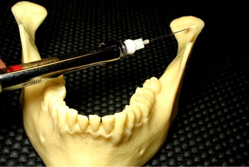 PDF Efficacy of GowGates Mandibular Nerve Block for The Extraction of Mandibular Molars