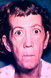 Semiologia médica: fácies SEMIOLOGIA MÉDICA: Fácies