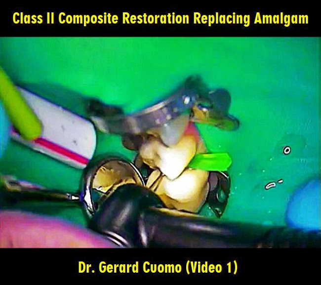 OPERATIVE DENTISTRY: Class II Composite Restoration Replacing Amalgam - Dr. Gerard Cuomo (Video 1)